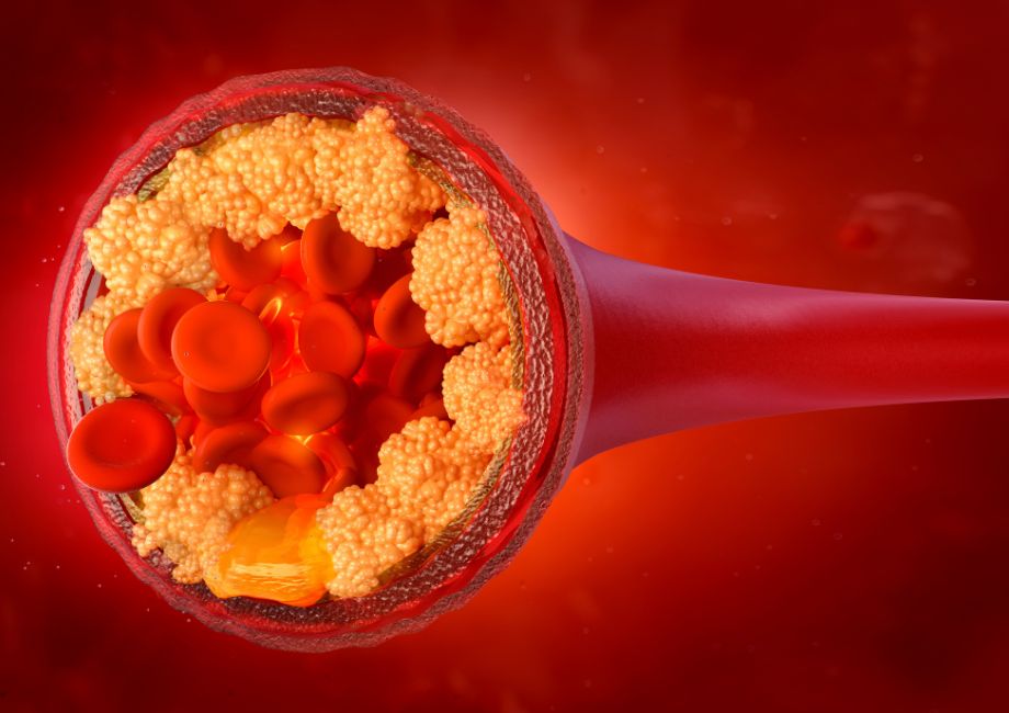 Graphic showing buildup of cholesterol in blood vessels